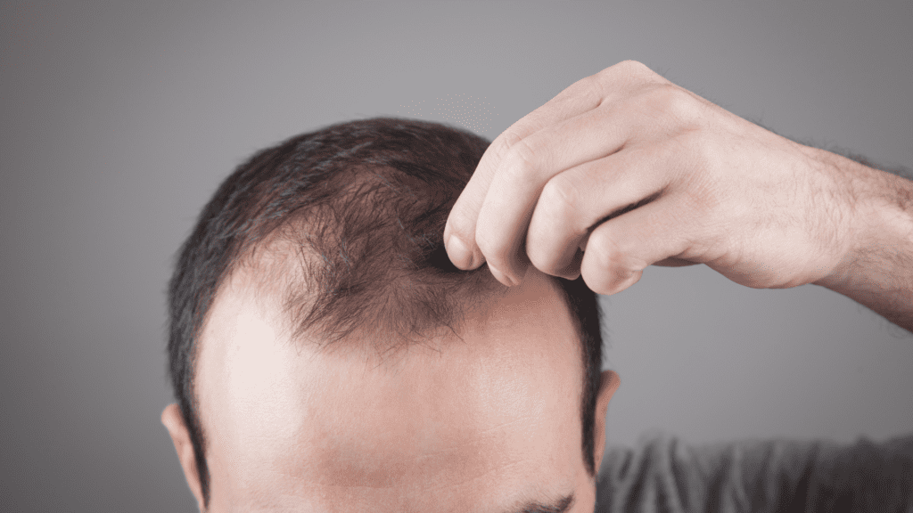 male pattern baldness dht